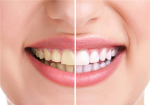 چگونه  دندان‌های سفید داشته باشیم