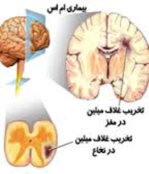 استان مرکزی دومین استان دارای بیشترین بیمار ام اسی