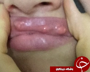 ژل تزریقی تقلبی چهره این زن را مانند هیولا کرد + تصاویر