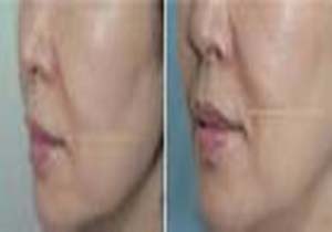 آنچه باید درباره هایفوتراپی بدانیم