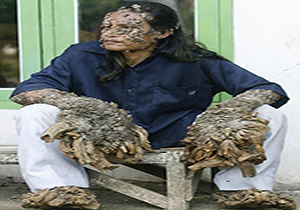 رشد درختی دست و پاهای مرد بنگلادشی
