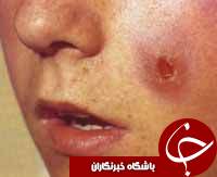 کاهش 25 درصدی ابتلا به بیماری سالک در ایلام