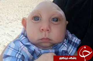 هراس جامعه پزشکی جهانی از تولد نوزادان فاقد جمجمه + تصاویر