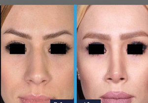 توصیه های بعد از جراحی بینی
