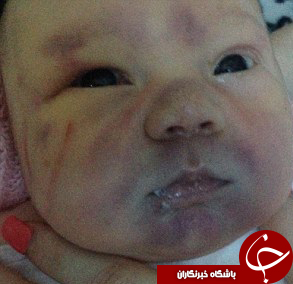کنده شدن بخشی از سر و جمجمه نوزاد حین زایمان طبیعی + تصاویر