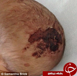 کنده شدن بخشی از سر و جمجمه نوزاد حین زایمان طبیعی + تصاویر