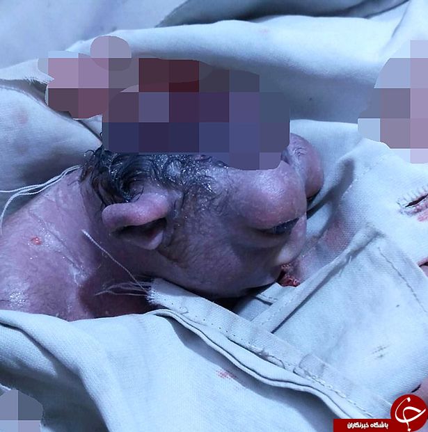 نوزادی که با یک نصفه سر بدنیا آمد+ عکس(18+)