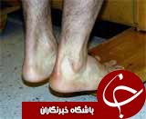 رایج ترین آسیب دیدگی پاشنه پای ورزشکاران/ دردی که مانع دویدن می شود