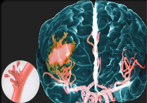 چگونه از سکته مغزی پیشگیری کنیم