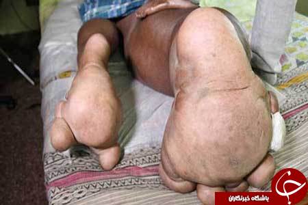 پایی به وزن یک بچه فیل+عکس