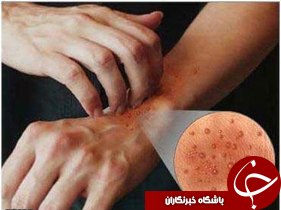 انواع قارچ های پوستی