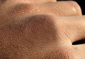 استفاده از سلول های پوستی برای کشتن سرطان
