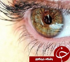 بیماری قوز قرنیه چیست؟