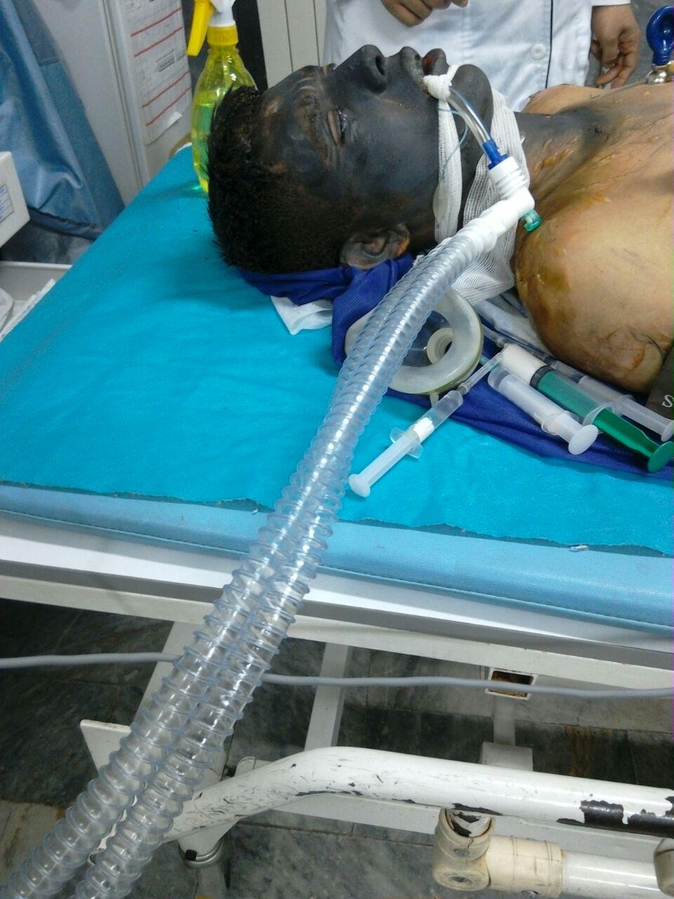 سوختگی 70 درصدی  بر اثر انفجار مواد محترقه