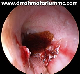 لانه گرم سوسک در گوش یک مرد+ عکس
