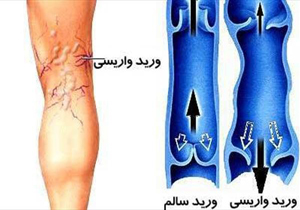 ترکیب جادویی برای درمان واریس