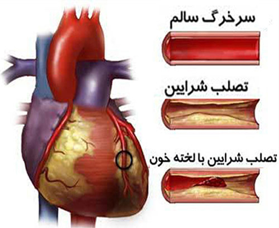 چه کسانی به تصلب شرایین مبتلا می&zwnj;شوند؟
