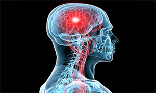 کاهش سن ابتلاء به سکته مغزی + صوت