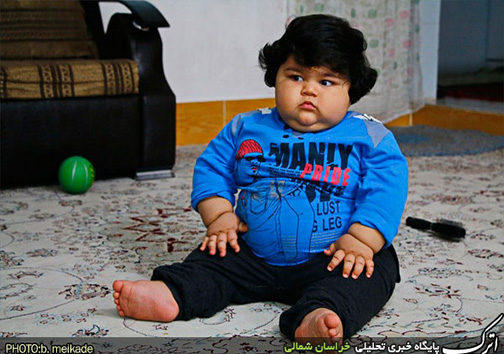کودک یک ساله بجنوردی با ۴۲ کیلو وزن