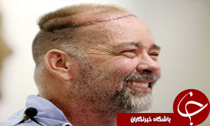 پیوند جمجمه و پوست سر انسان +عکس