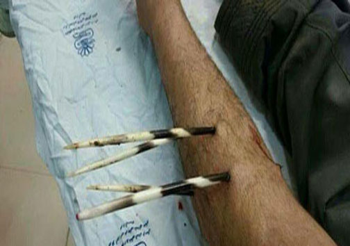 حمله جوجه&zwnj;تیغی به کشاورز لرستانی (+عکس)