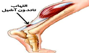 اغلب موارد التهاب تاندون آشیل به طور کامل بهبود می‌یابد