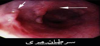 گلستان قطب سرطان مری در جهان