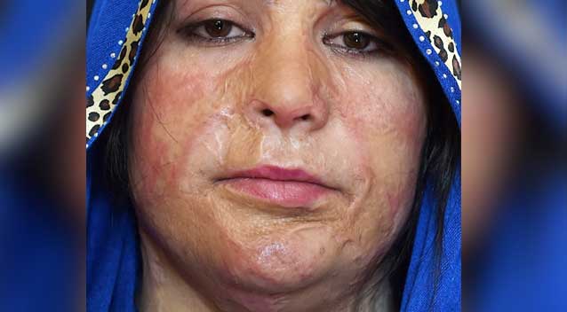 صحبت&zwnj;های تکان&zwnj;دهنده قربانی 22 ساله اسید پاشی/ ممتاز: هنوز صدای جیغ&zwnj;هایم را می&zwnj;شنوم + عکس