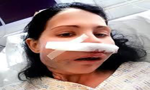 سرطان نادر باعث تخلیه کامل نیمی از صورت این زن شد +&zwnj; تصاویر