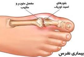 شیوع قابل ملاحظه نقرس در بین جوانان