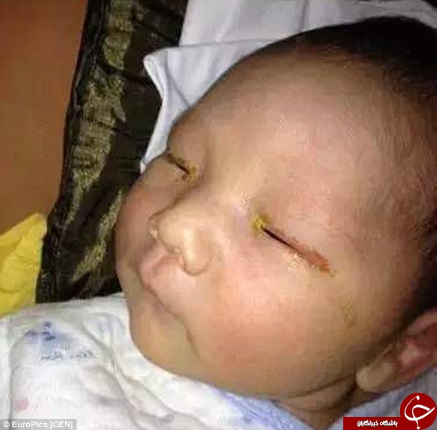 فلش دوربین نوزاد سه ماهه را نابینا کرد!+عکس