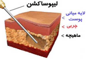 لیپوساکشن به تنهایی قادر به کم کردن وزن نیست