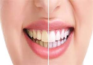 آیا جرم‌گیری به دندان‌ها آسیب می‌رساند؟