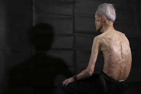 زخمهای هفتاد ساله بمباران ناگازاکی بر بدن یک مرد+تصاویر