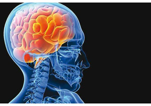 سکته مغزی چیست؟