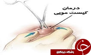 کیست مویی، بیماری شایع دوران جوانی است