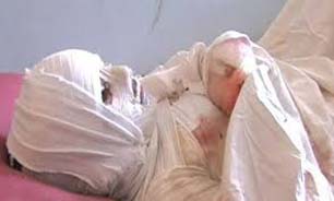 جای رسانه در برنامه پیشگیرانه سوختگی خالی است