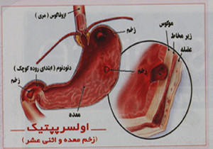 زخمی که معده را سوراخ می‌کند!