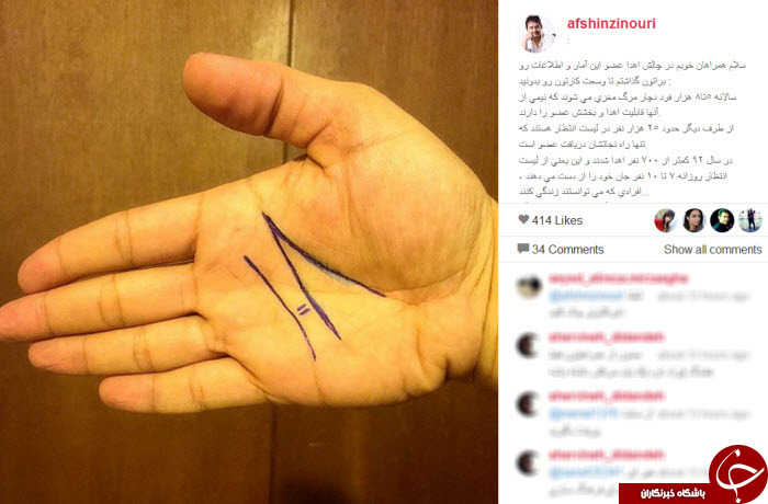 چالش اهدای عضو