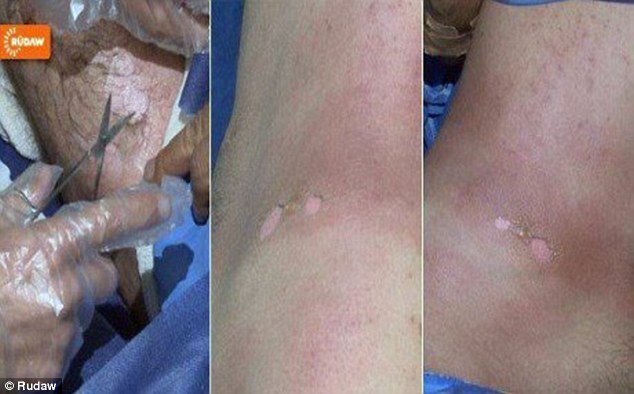 تصاویری تکان دهنده از کاربرد گاز خردل بوسیله داعش