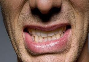 دندان قروچه با زیبایی صورت شما چه می‌کند؟