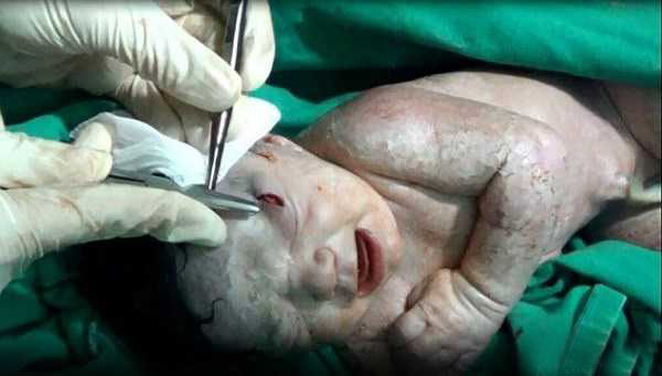 جراحی نوزاد و مادر ترکش خورده در سوریه