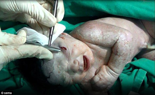 نجات اولین نوزادی که قبل از به دنیا آمدن مجروح بود+ تصاویر