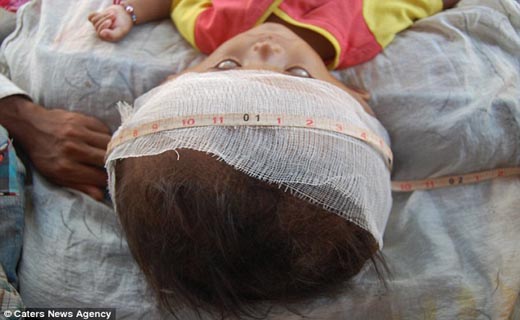 کودک هندی در انتظار انفجار جمجمه + تصاویر