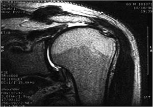 آرتروگرافی جایگزین مناسبی برای MRI
