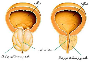 ۴ هزار تومان برای تشخیص سرطان پروستات
