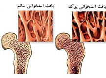 از کودکی جلوی بیماری "خاموش" را بگیرید!