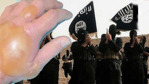 بلایی که گاز خردل داعش بر سر کُردهای عراق آورد (تصاویر+16)