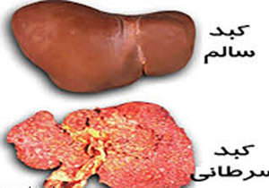 سرطان کبد در مناطق جنوبی کرمان شایع تر است