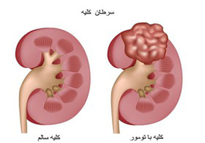 دو داروی جدید برای درمان سرطان کلیه